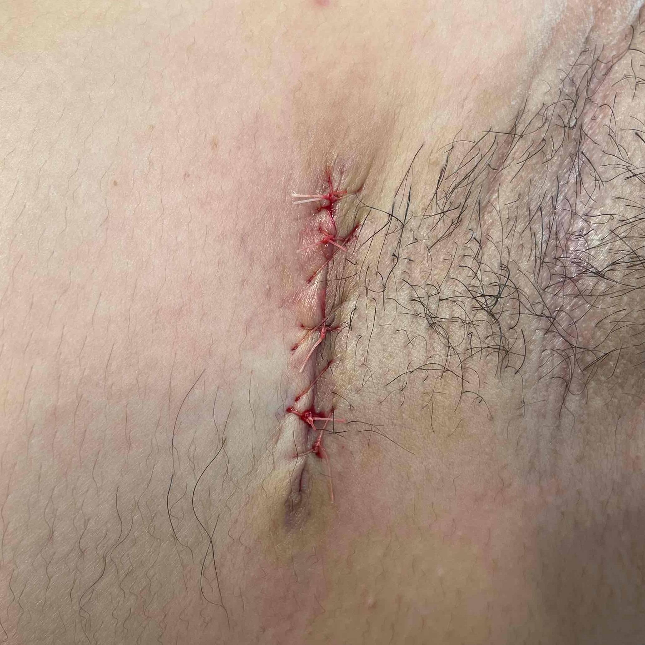 Cyst Removal Before and After Case-26 After