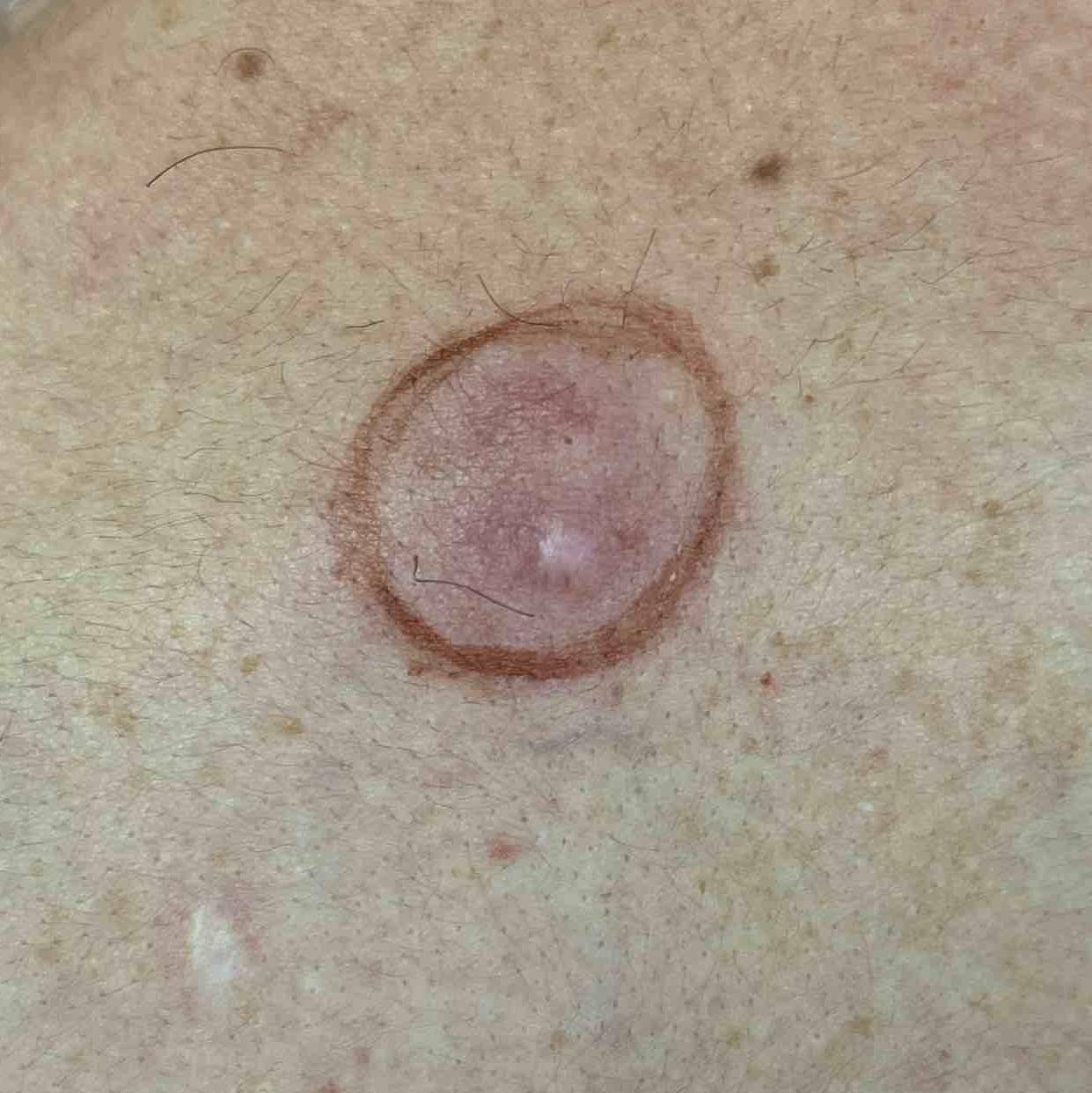 Cyst Removal Before and After Case-27 Before