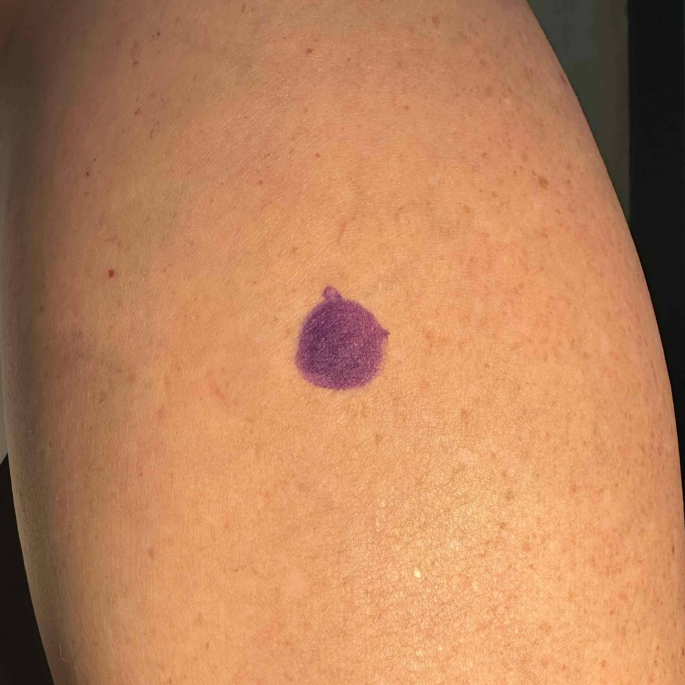 Cyst Removal Before and After Case-28 Before
