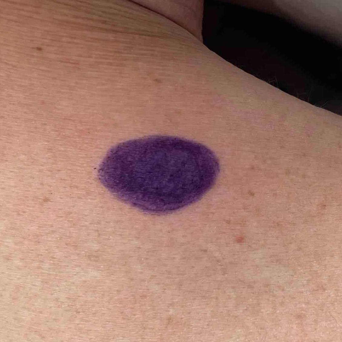 Cyst Removal Before and After Case-29 Before