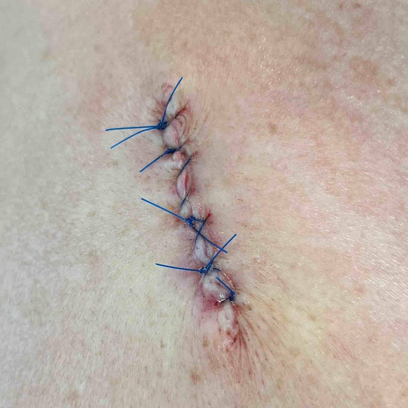 Cyst Removal Before and After Case-29 After