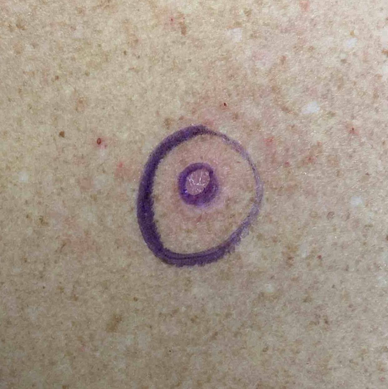 Skin Cancer (Excision) Case-82 Before