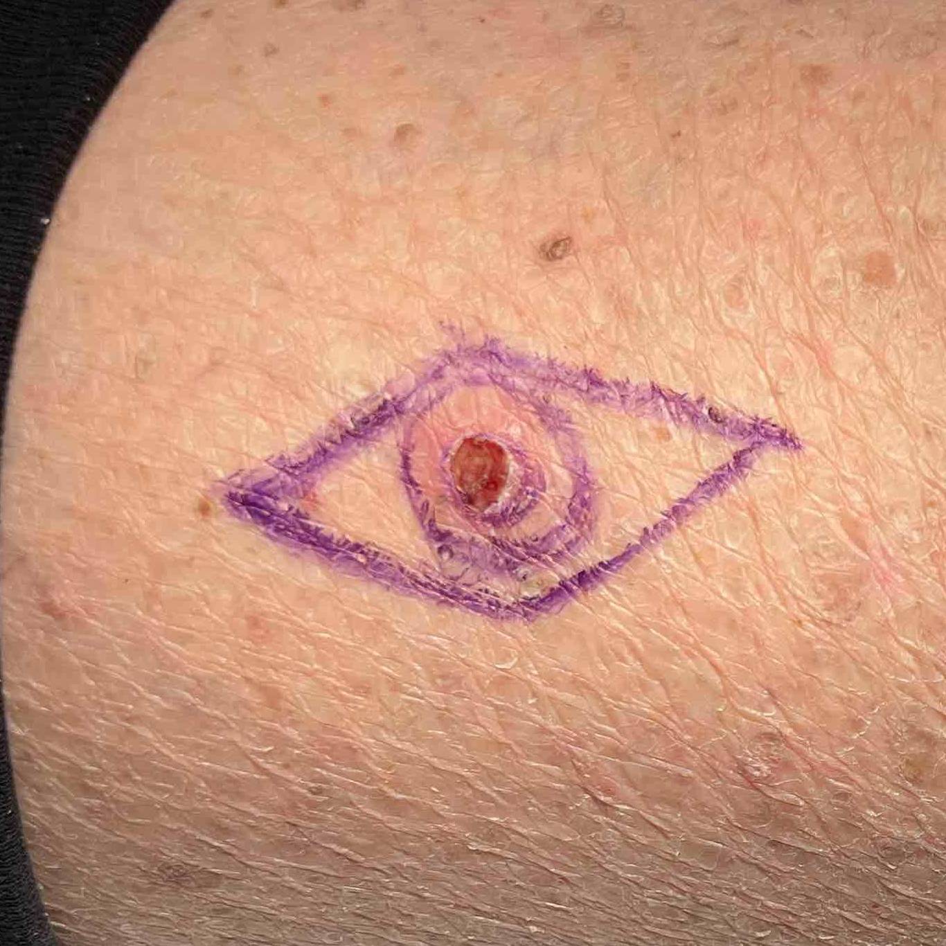 Skin Cancer (Excision) Case-83 Before