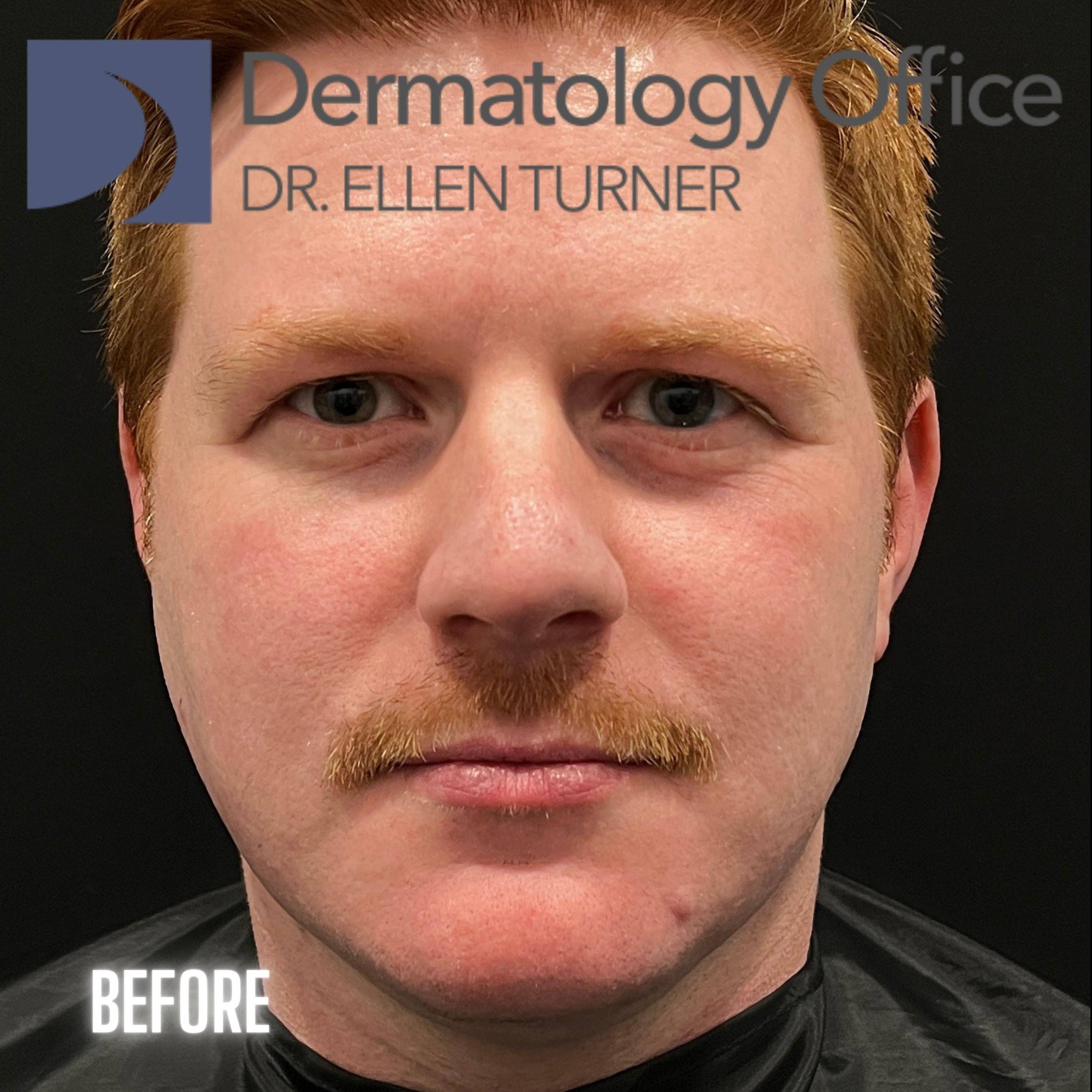 Snatch and Lift (4 treatments EMFACE and 4 syringes Volux XC) Before and After Case-3 Before