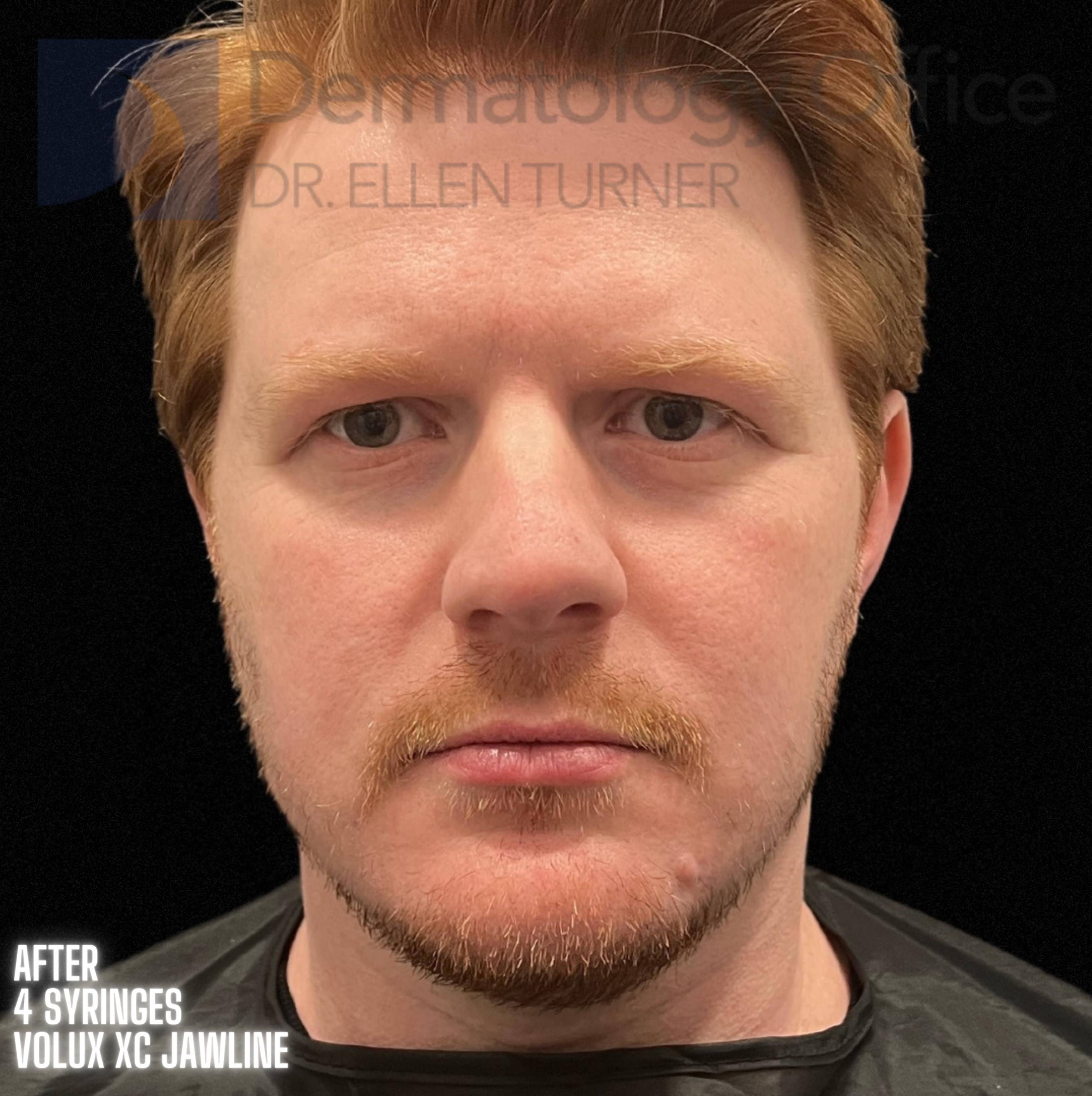 Snatch and Lift (4 treatments EMFACE and 4 syringes Volux XC) Before and After Case-3 After