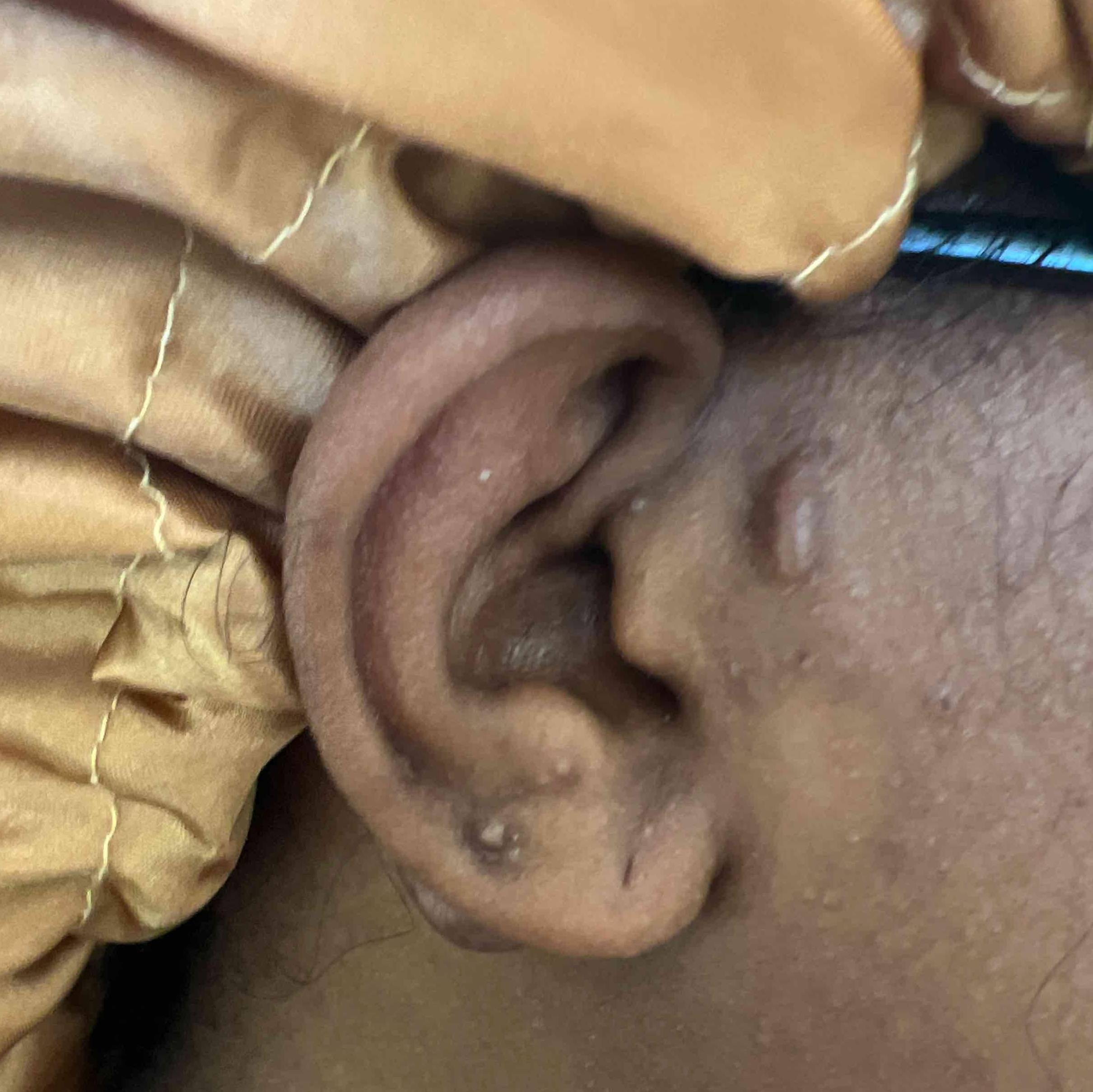 Keloids Before and After Case-18 Before