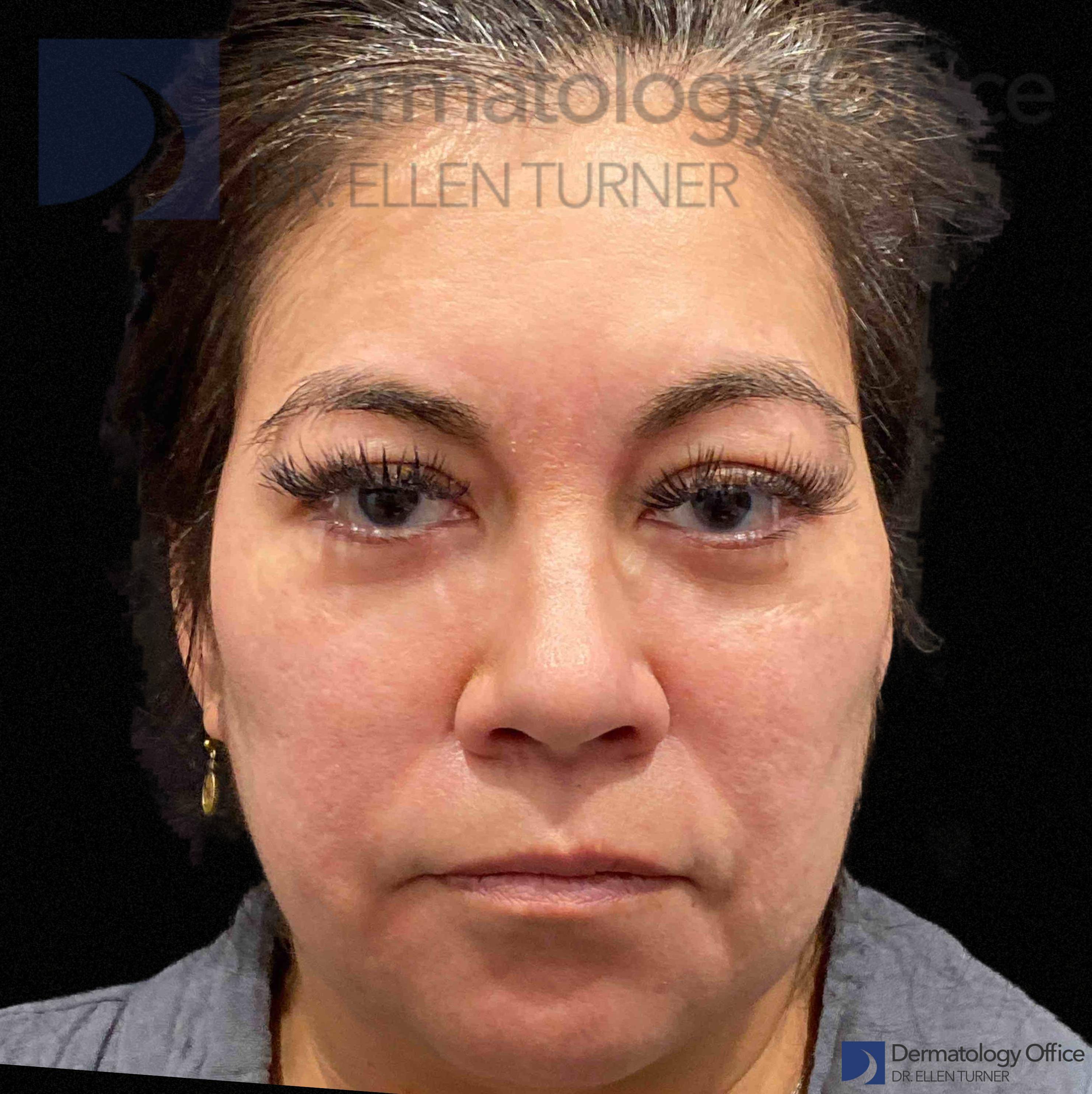 EMFACE (4 treatments) Before and After Case-57 Before