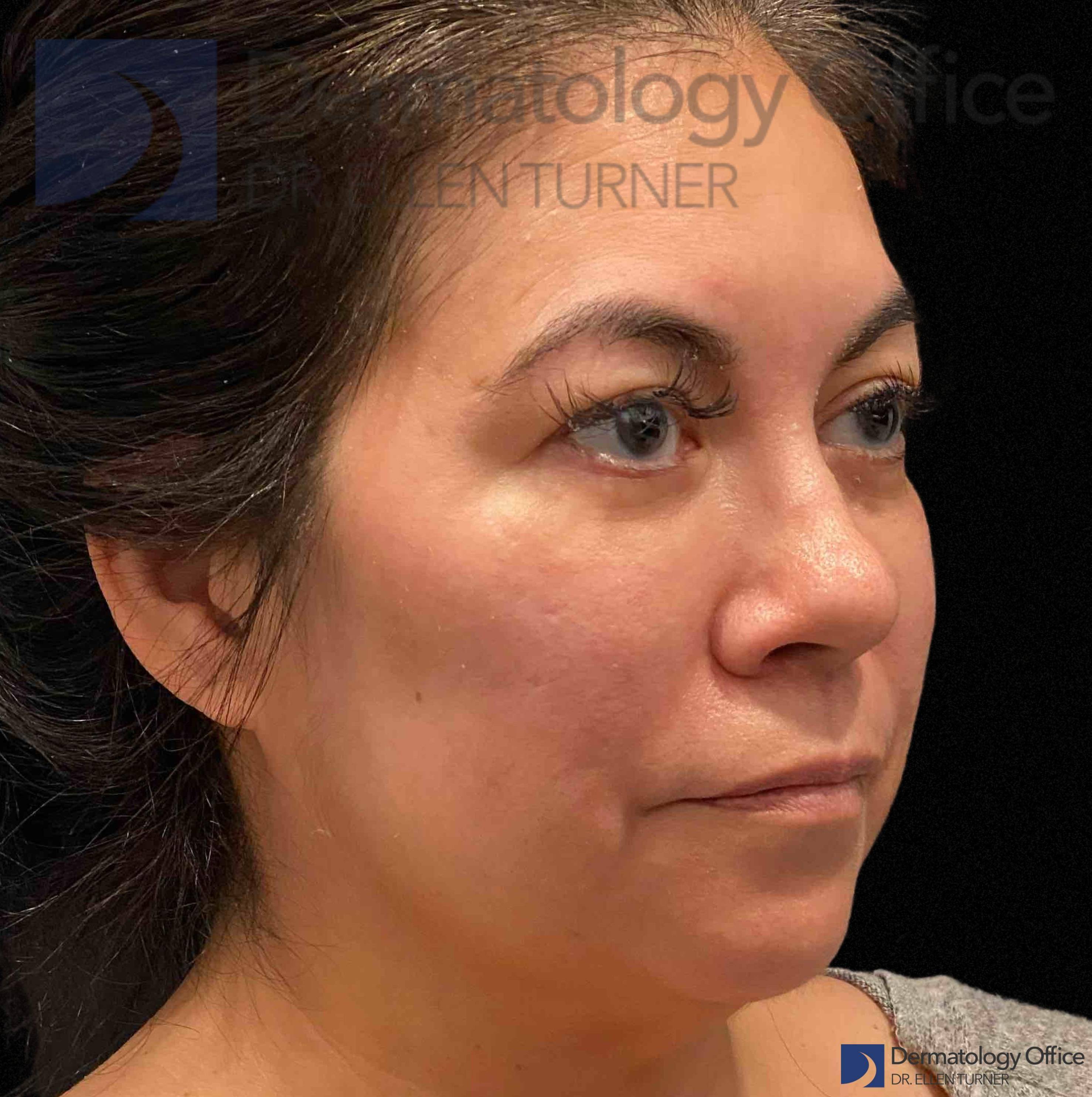 EMFACE (4 treatments) Before and After Case-58 After