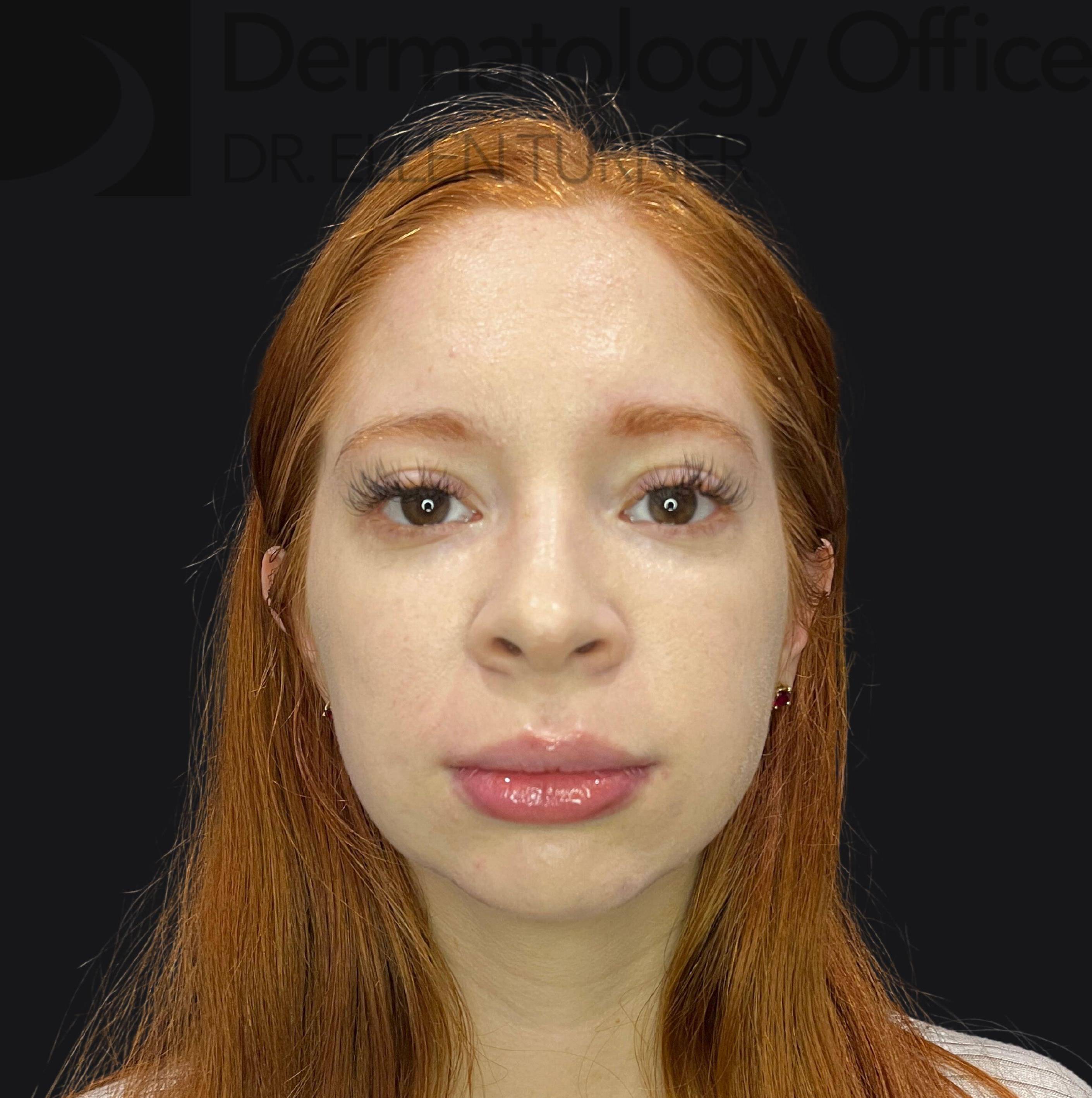 Volux (4 syringes) Before and After Case-26 After