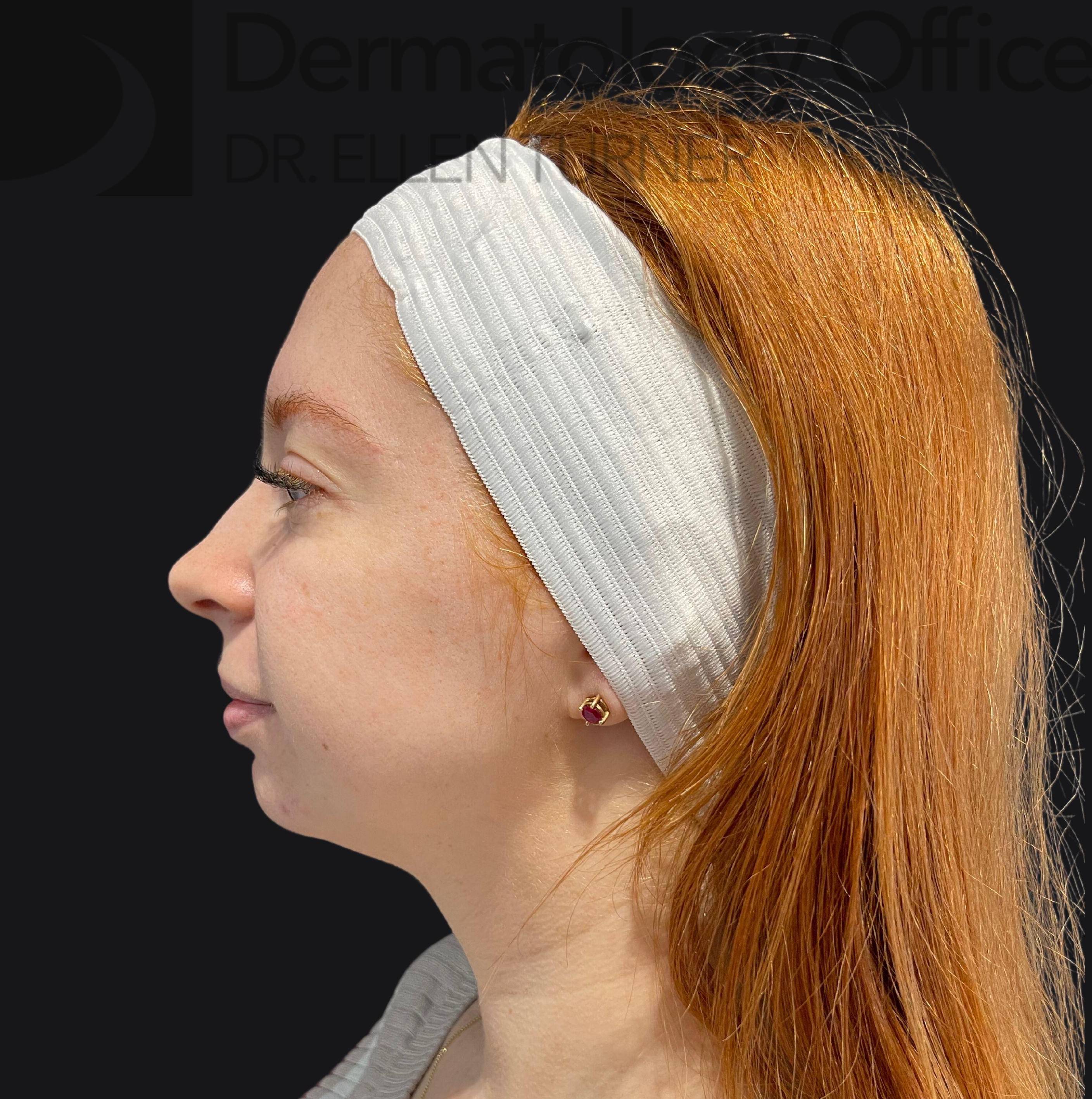 Volux (4 syringes) Before and After Case-27 Before