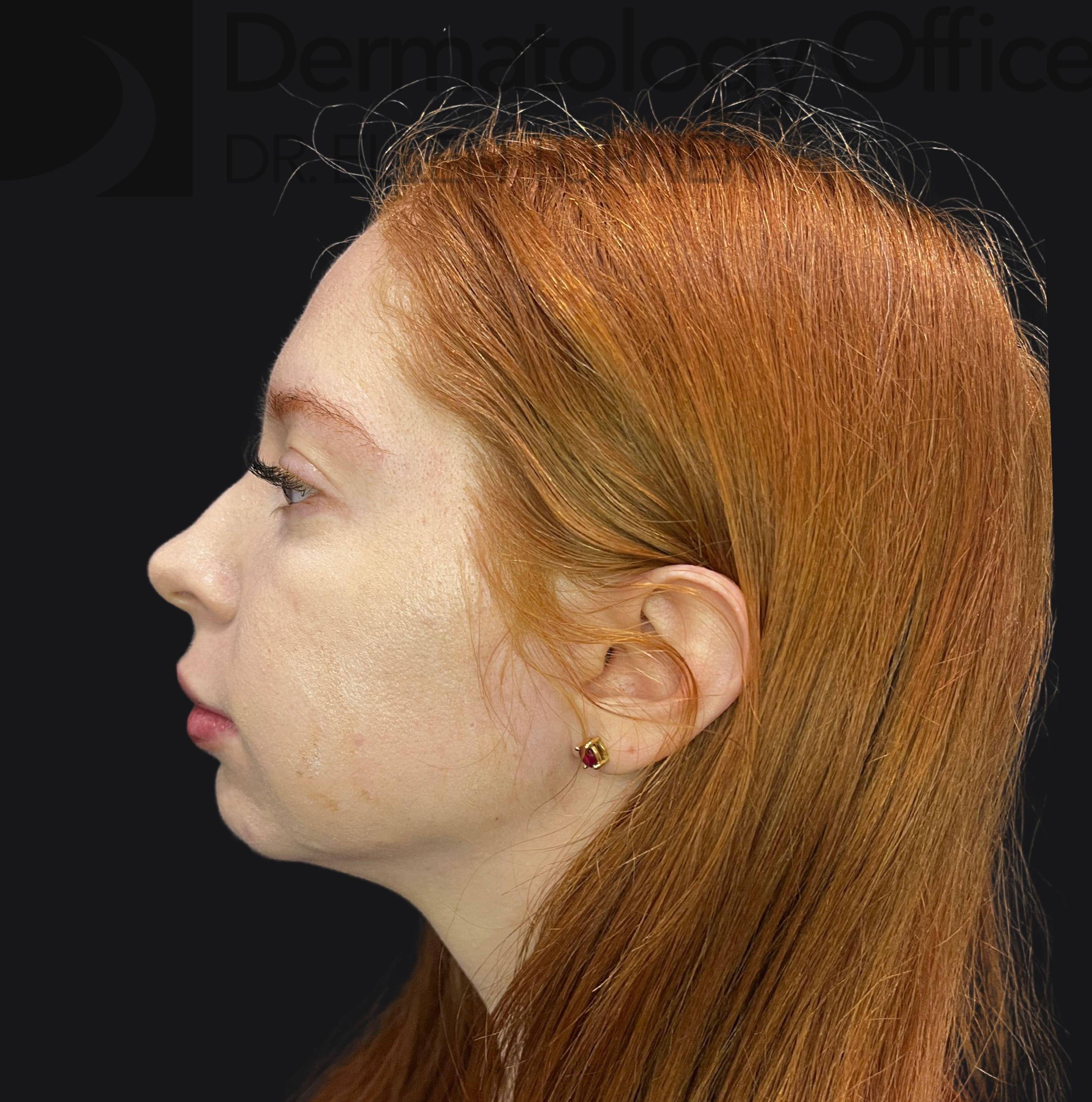 Volux (4 syringes) Before and After Case-27 After