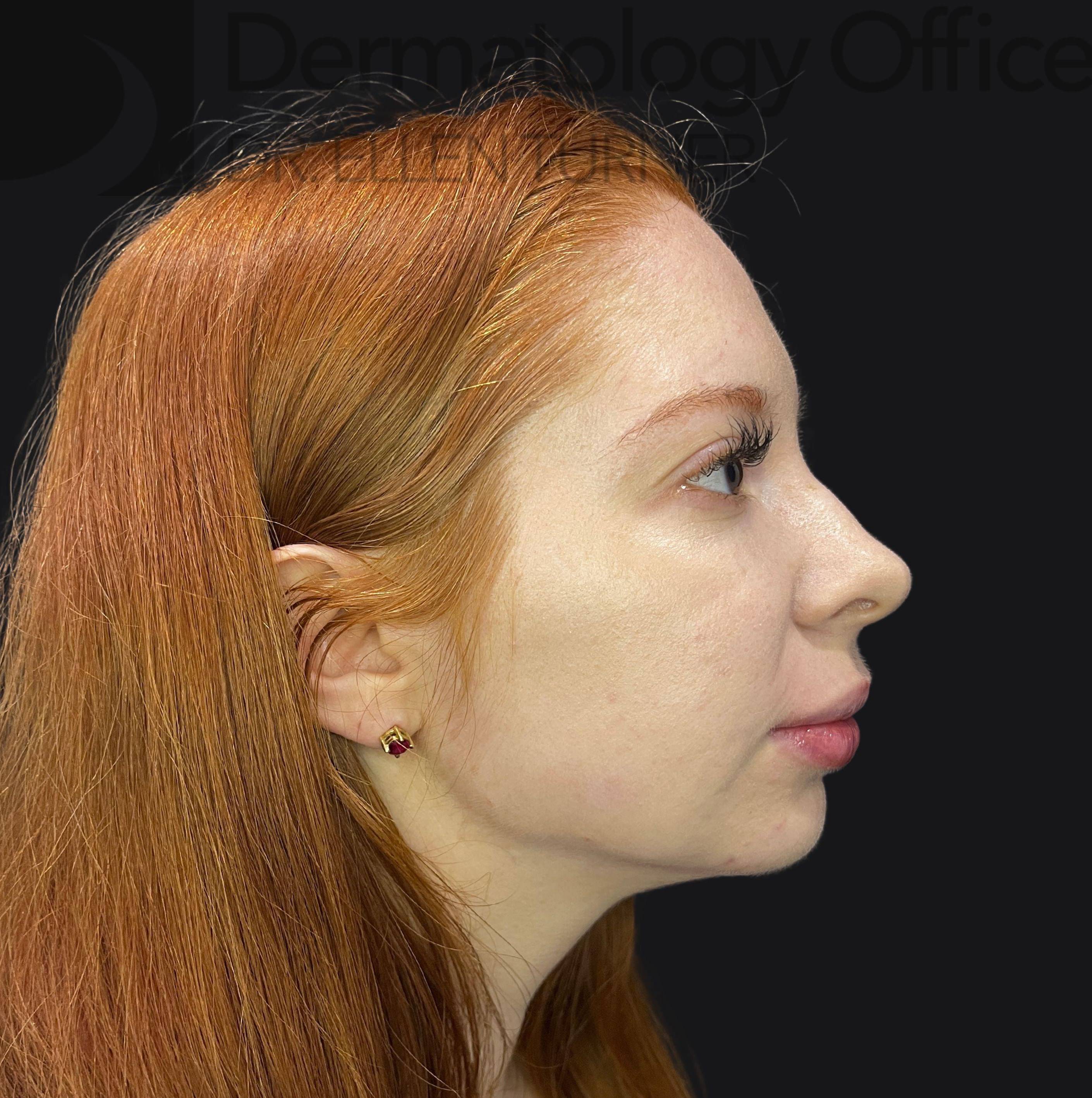 Volux (4 syringes) Before and After Case-28 After