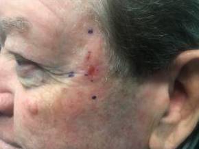 Skin Cancer Before and After Case 1 Before