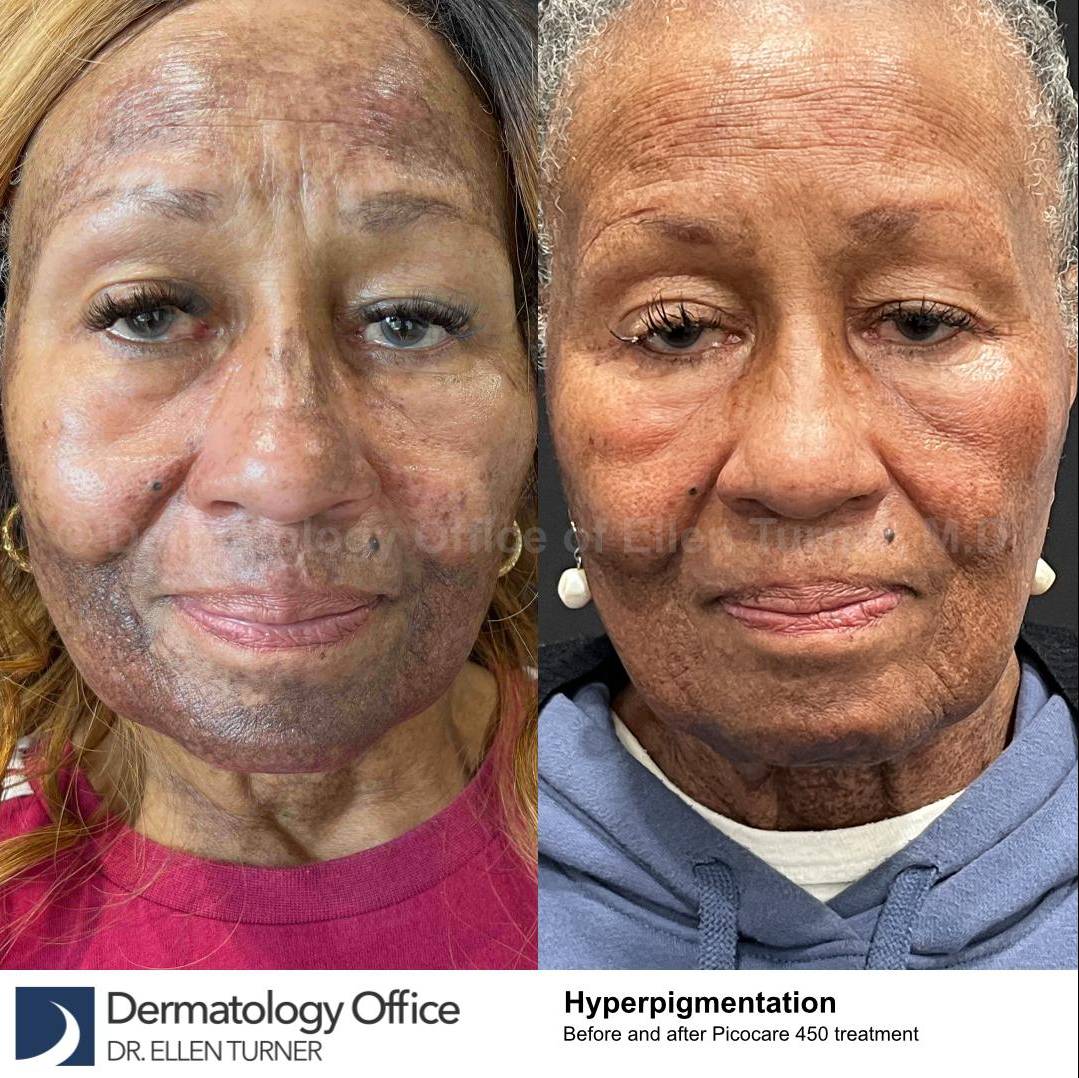 Picocare 450 Before and After Case-6 