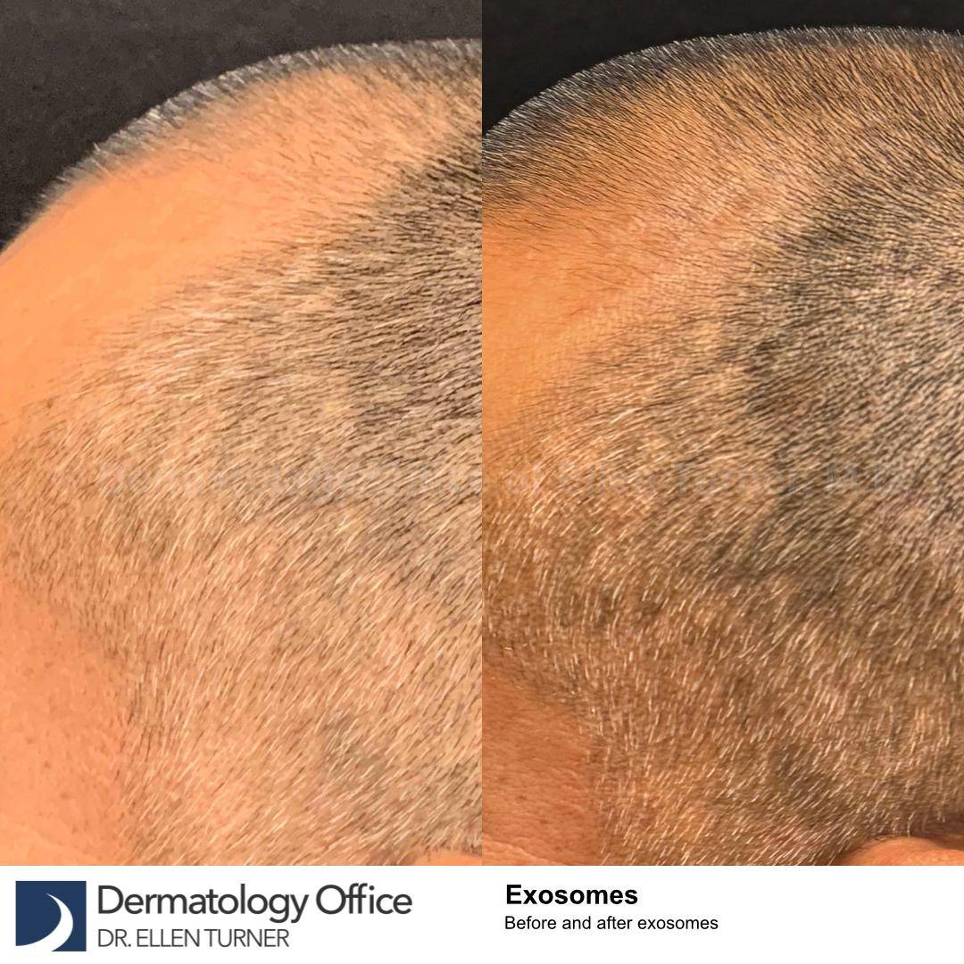 Exosomes Case-10 
