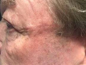 Skin Cancer Before and After Case 1 After