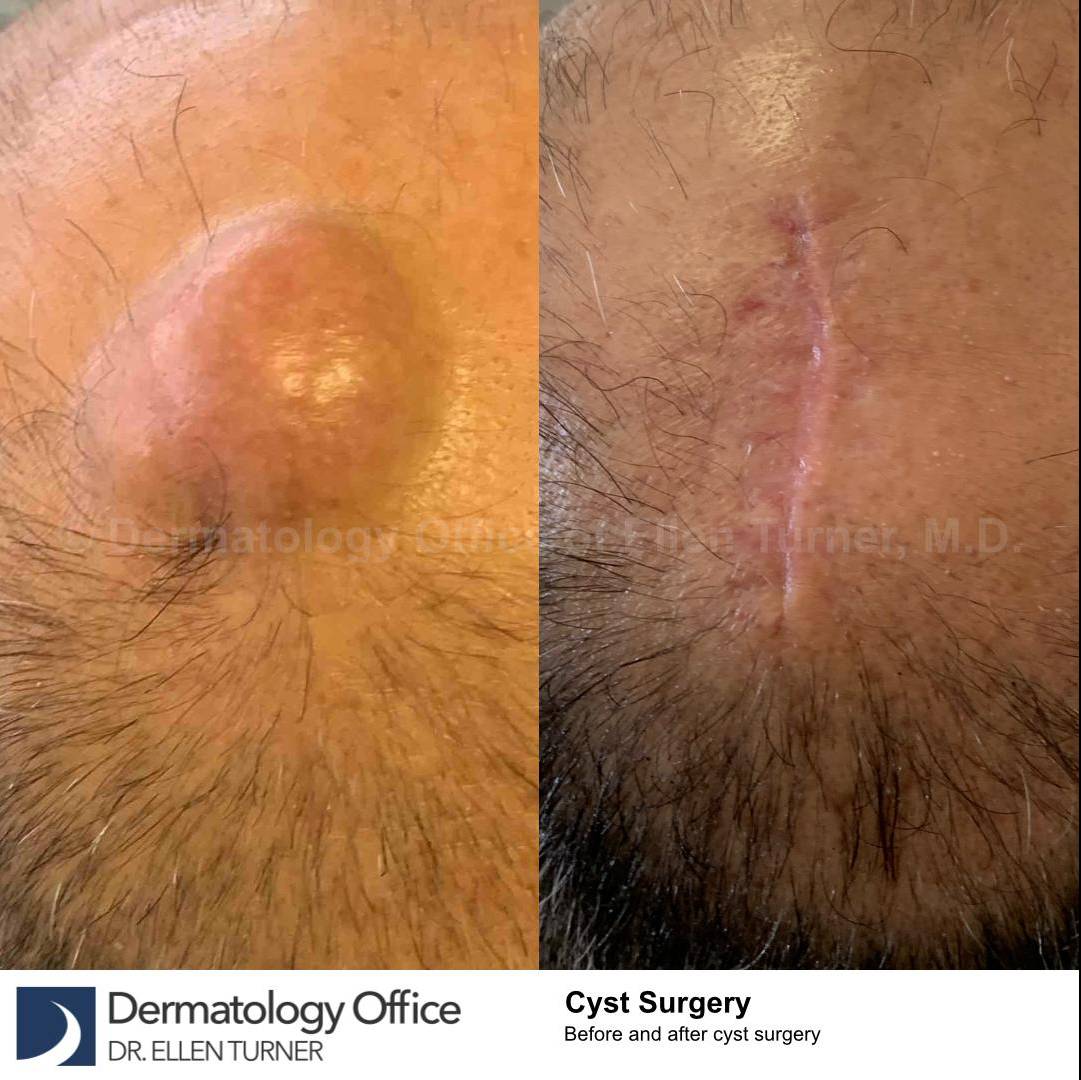 Cyst Removal Before and After Case-40 