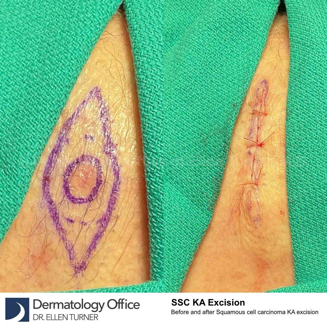 Before and After Skin Cancer (Excision) Case-84 