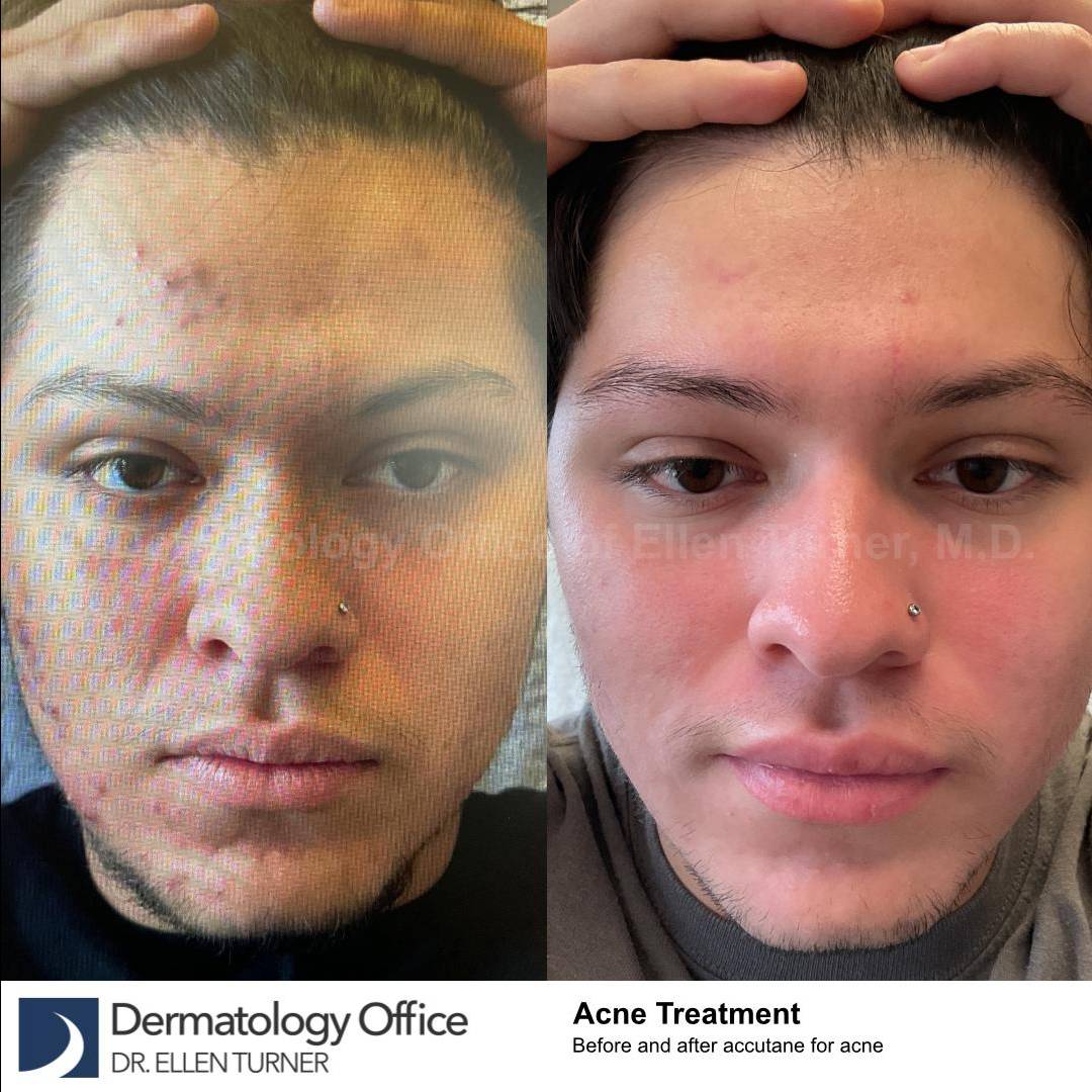 Acne Before and After Case-23 