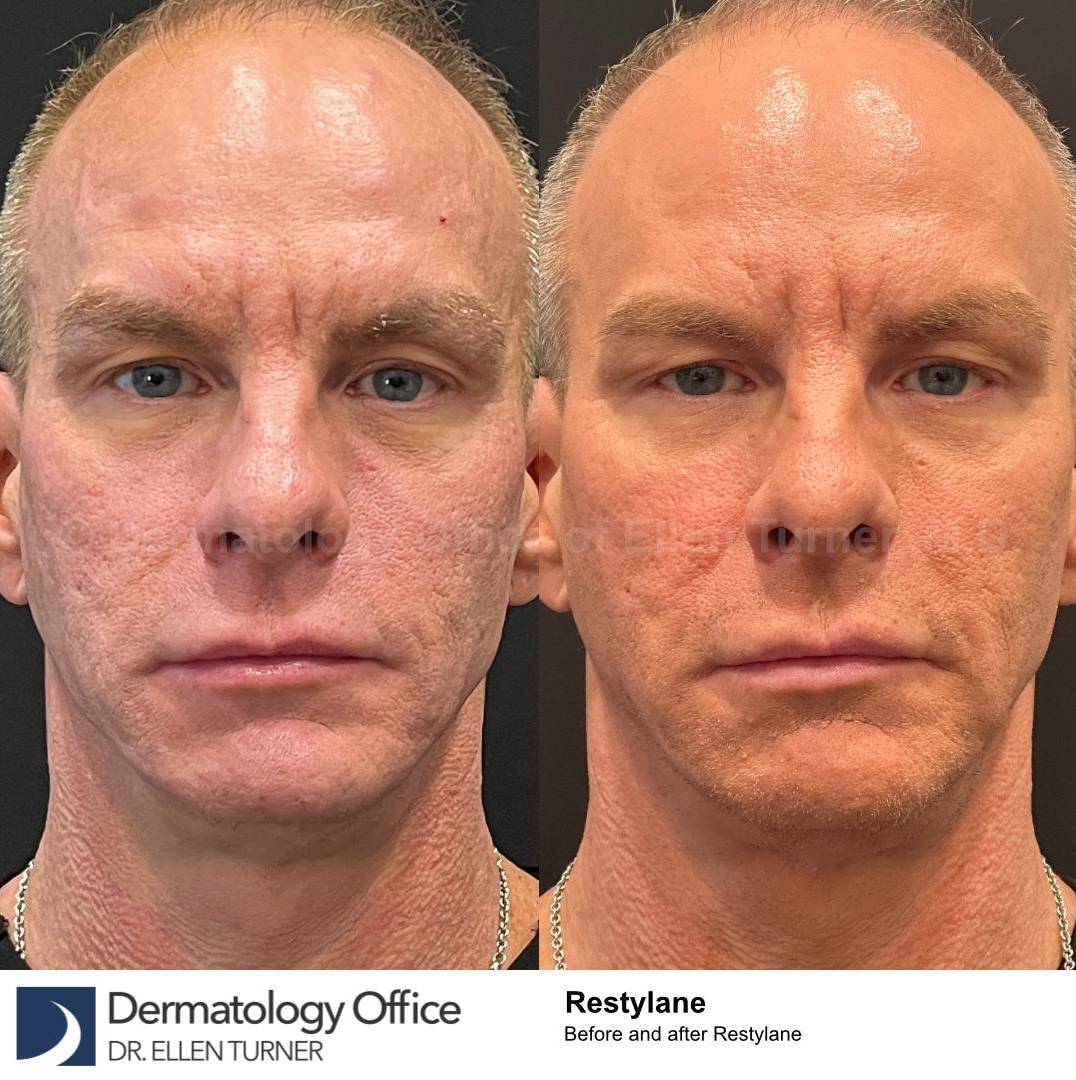 Restylane Before and After Case 12 