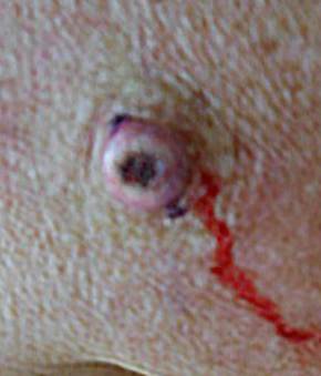 Skin Cancer Before and After Case 2 Before