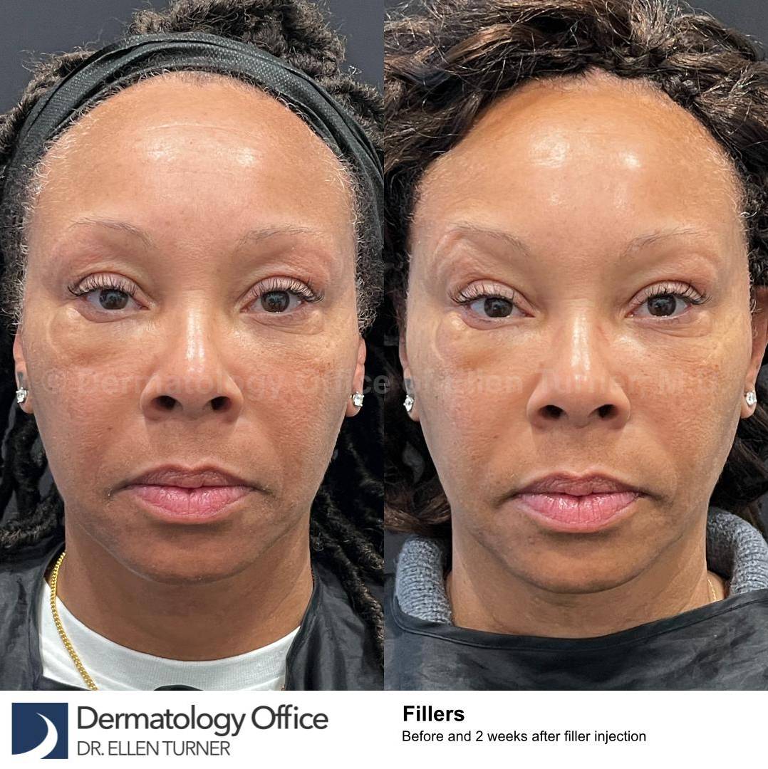 Restylane Before and After Case 22 