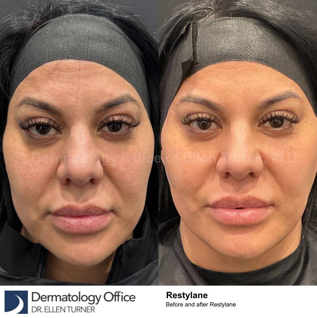 Restylane Before and After Case 13 