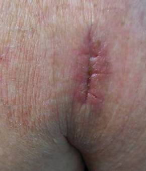 Skin Cancer Before and After Case 2 After