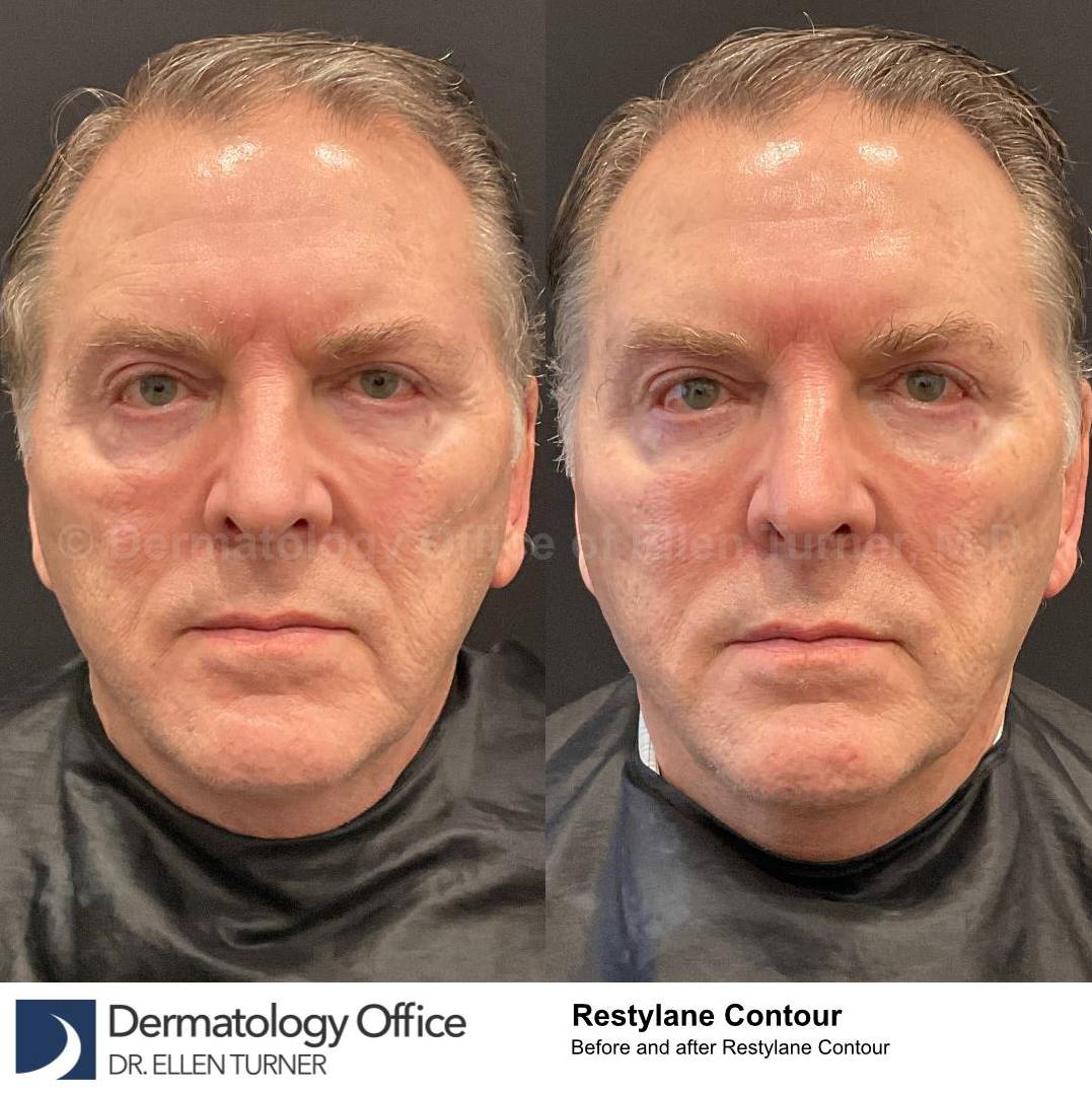 Restylane Before and After Case 14 