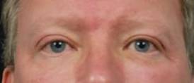 Restylane<sup>®</sup> Before and After Case 2 After