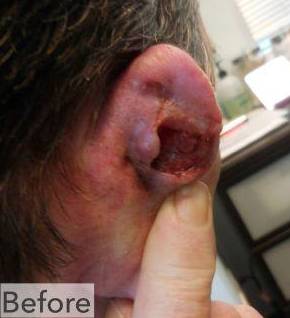 Skin Cancer Before and After Case 3 Before