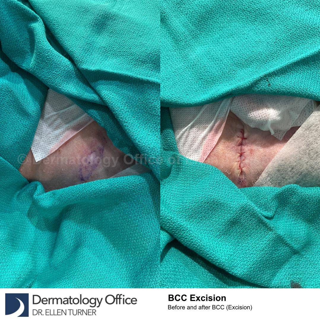 Skin Cancer (Excision) Case-86 