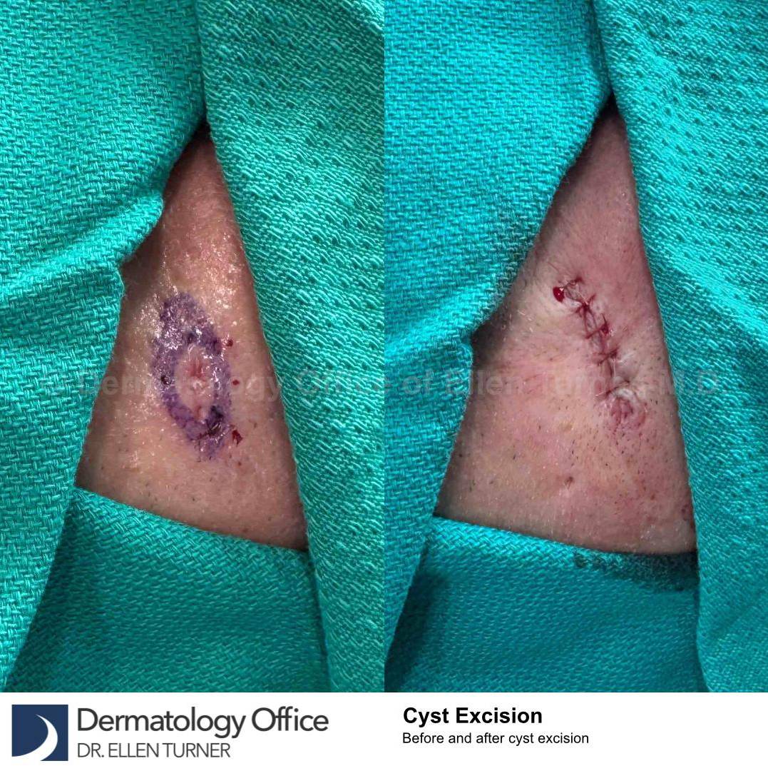 Cyst Removal Before and After Case-41 