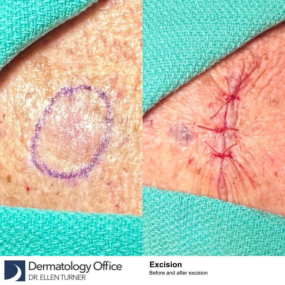 Cyst Removal Before and After Case-42 