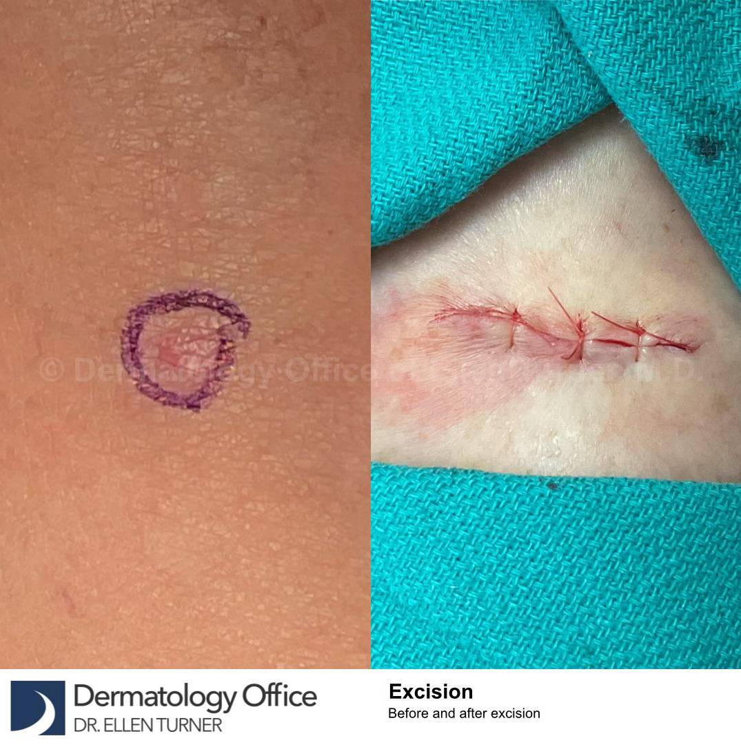 Cyst Removal Before and After Case-43 