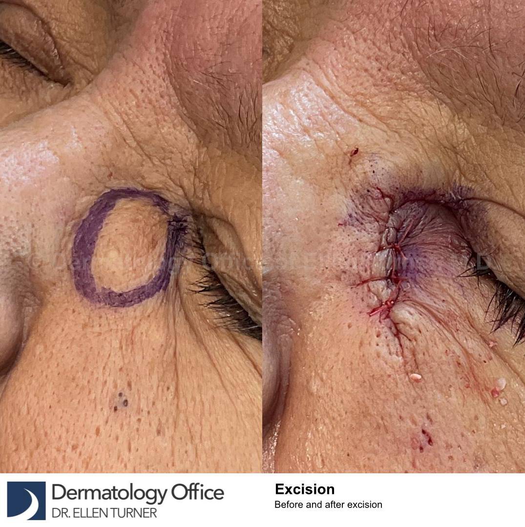 Cyst Removal Before and After Case-44 