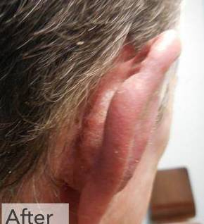 Skin Cancer Before and After Case 3 After