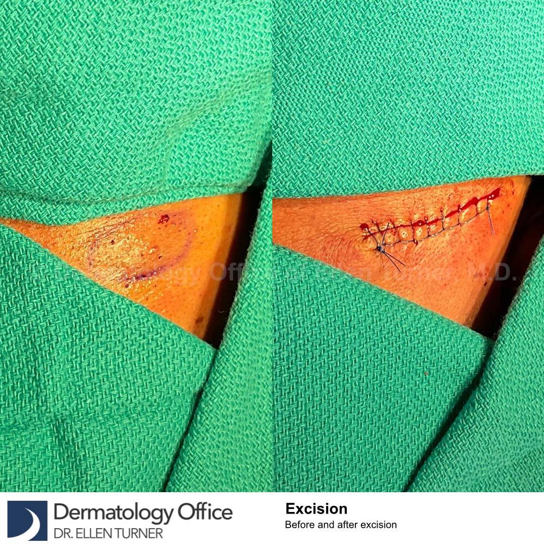 Cyst Removal Before and After Case-45 