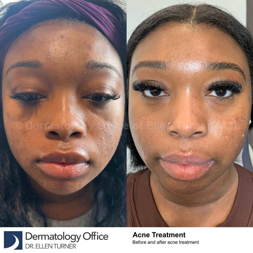 Acne Before and After Case-24 