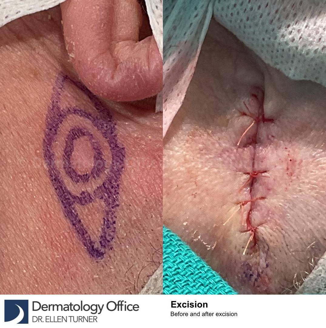 Cyst Removal Before and After Case-46 