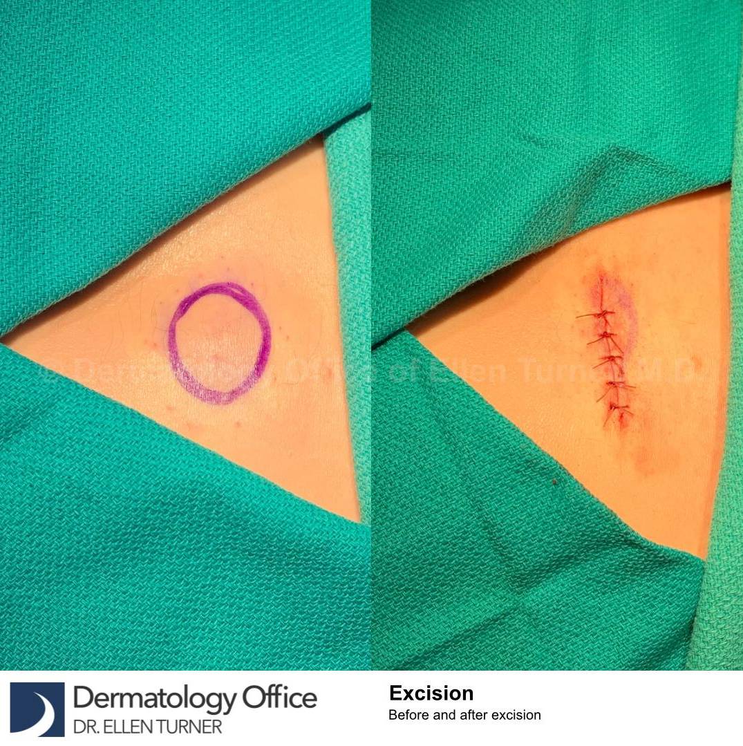 Cyst Removal Before and After Case-47 