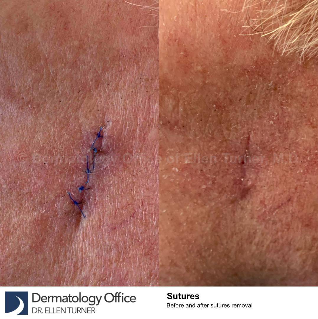 Cyst Removal Before and After Case-48 