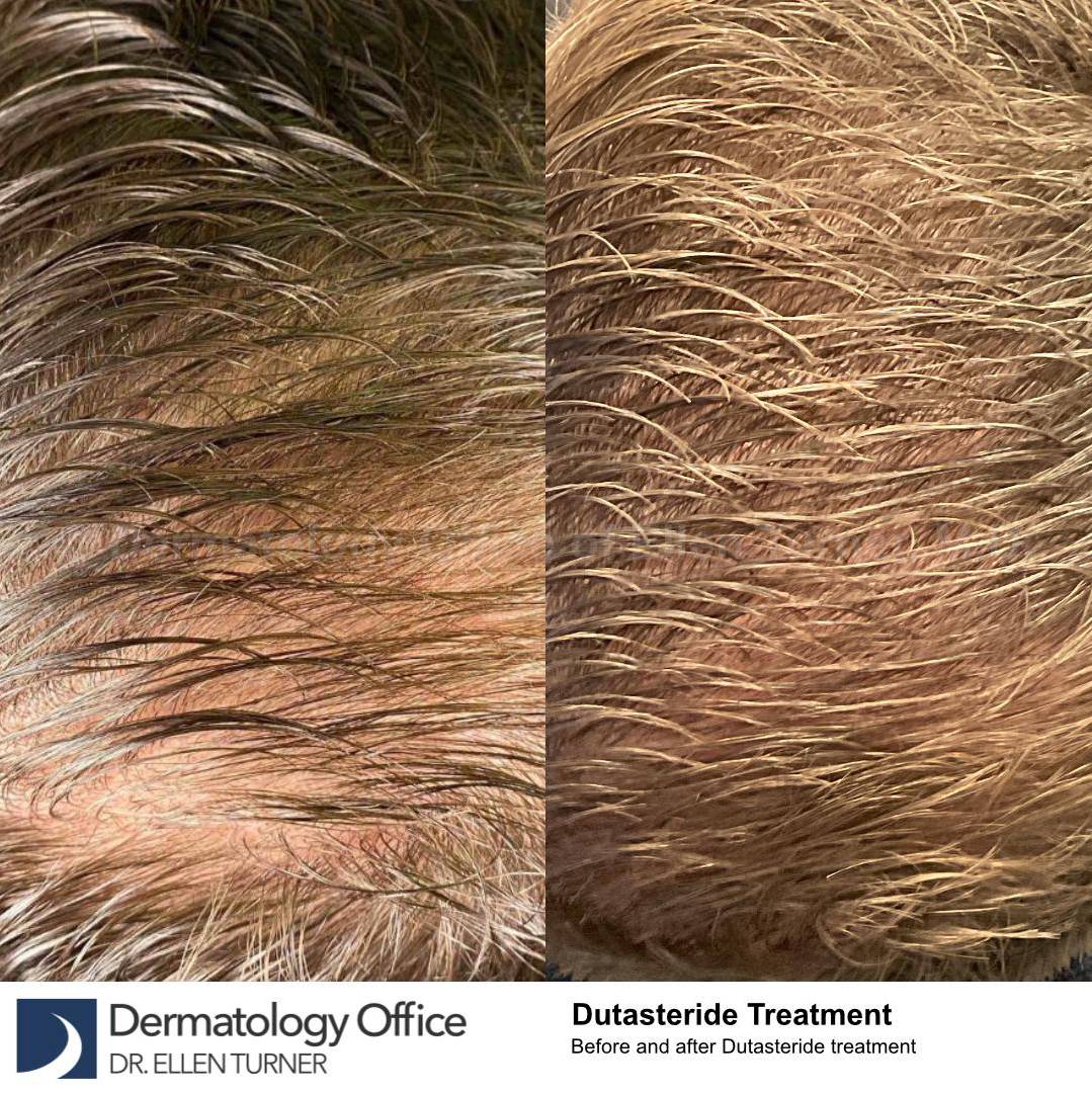 Hair Loss Before and After Case-15 