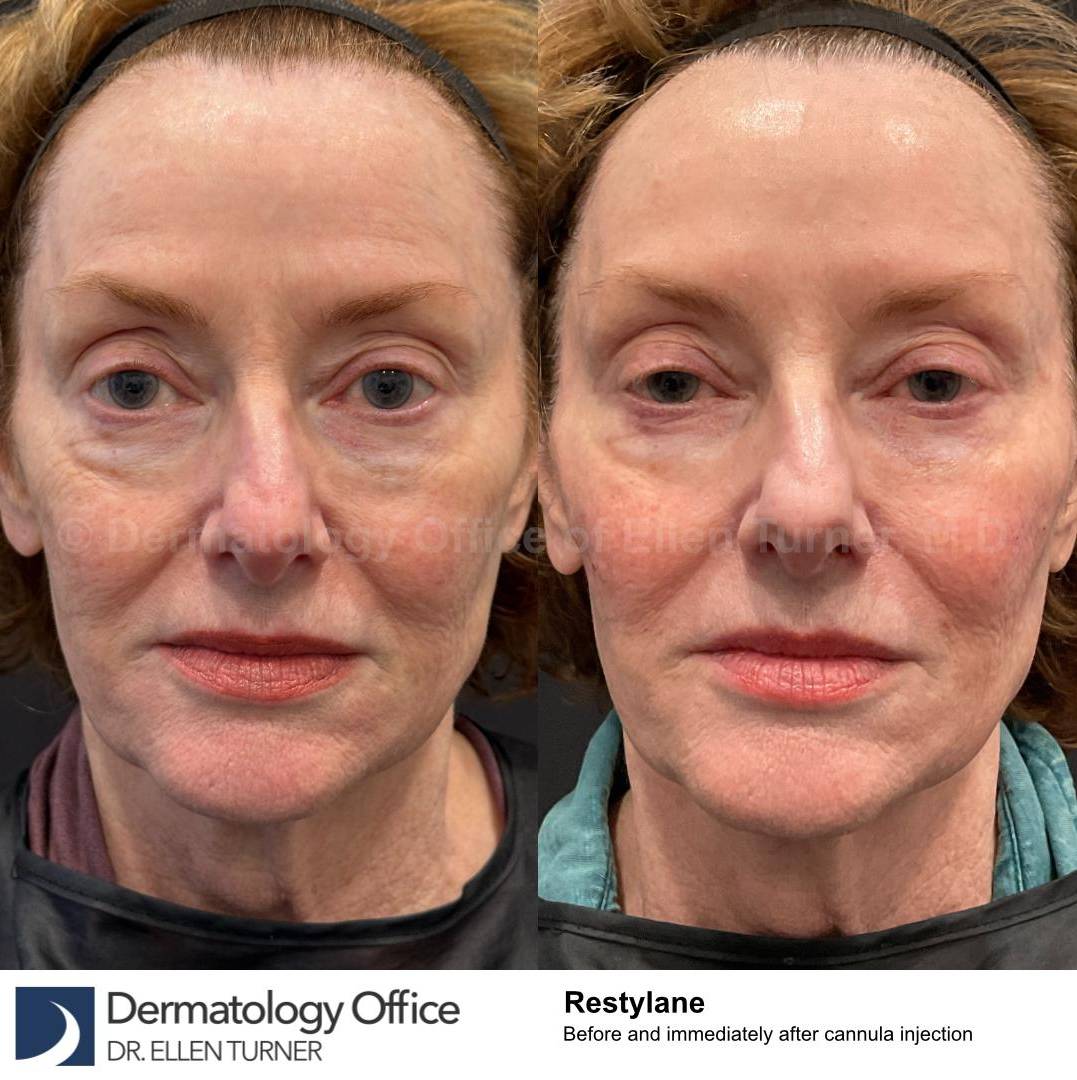 Restylane Before and After Case 16 