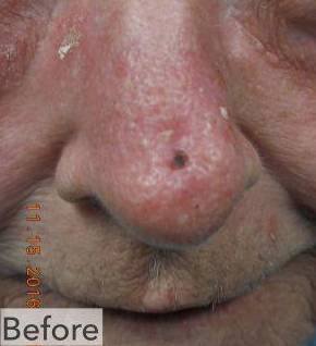Skin Cancer Before and After Case 4 Before