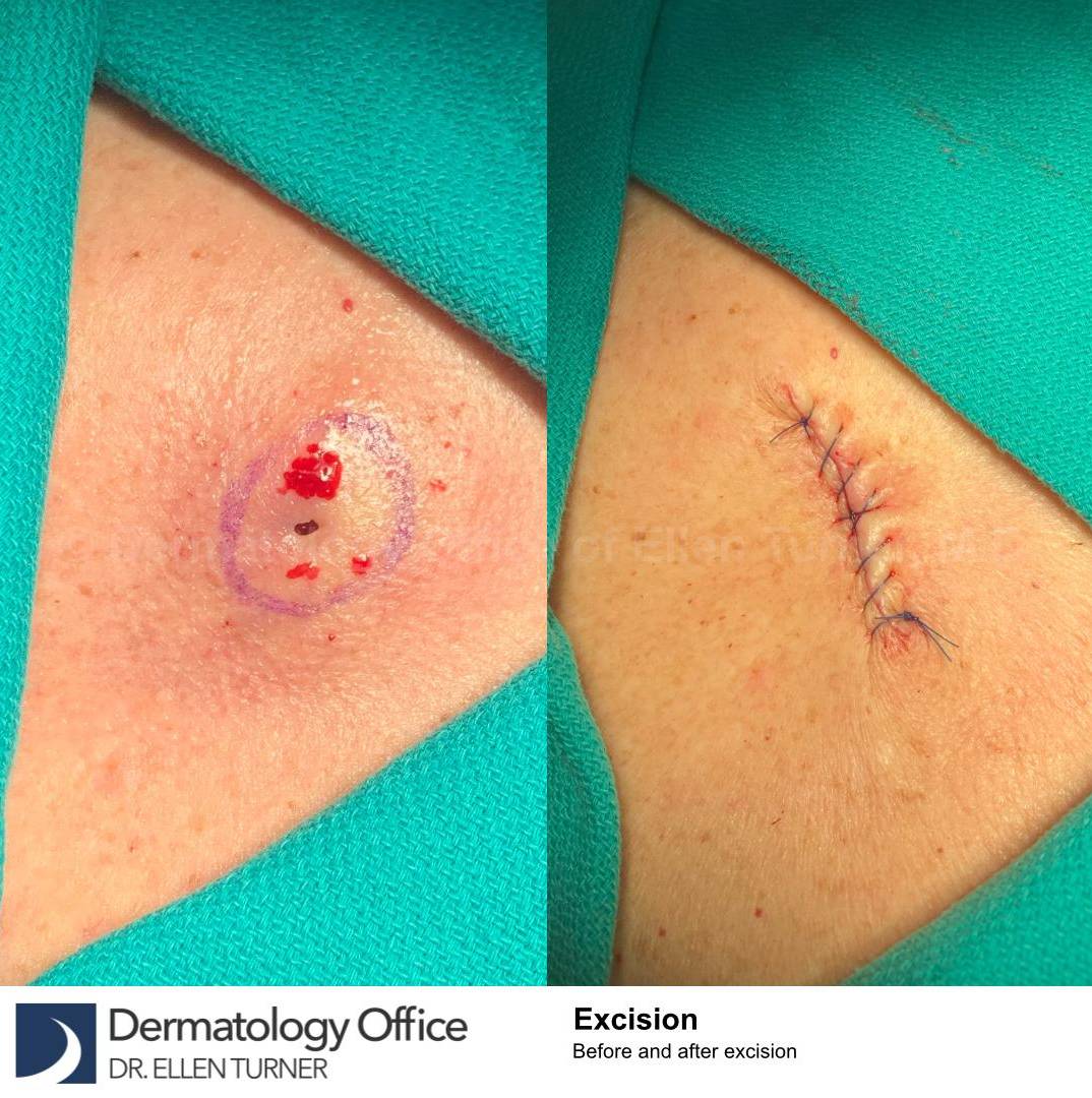 Cyst Removal Before and After Case-49 