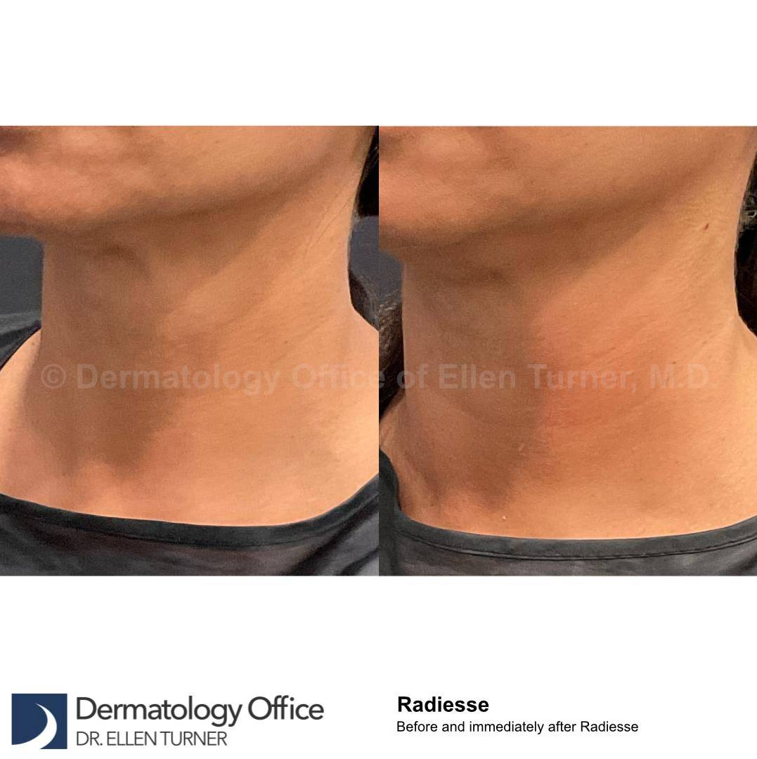 Radiesse Before and After Case 16 