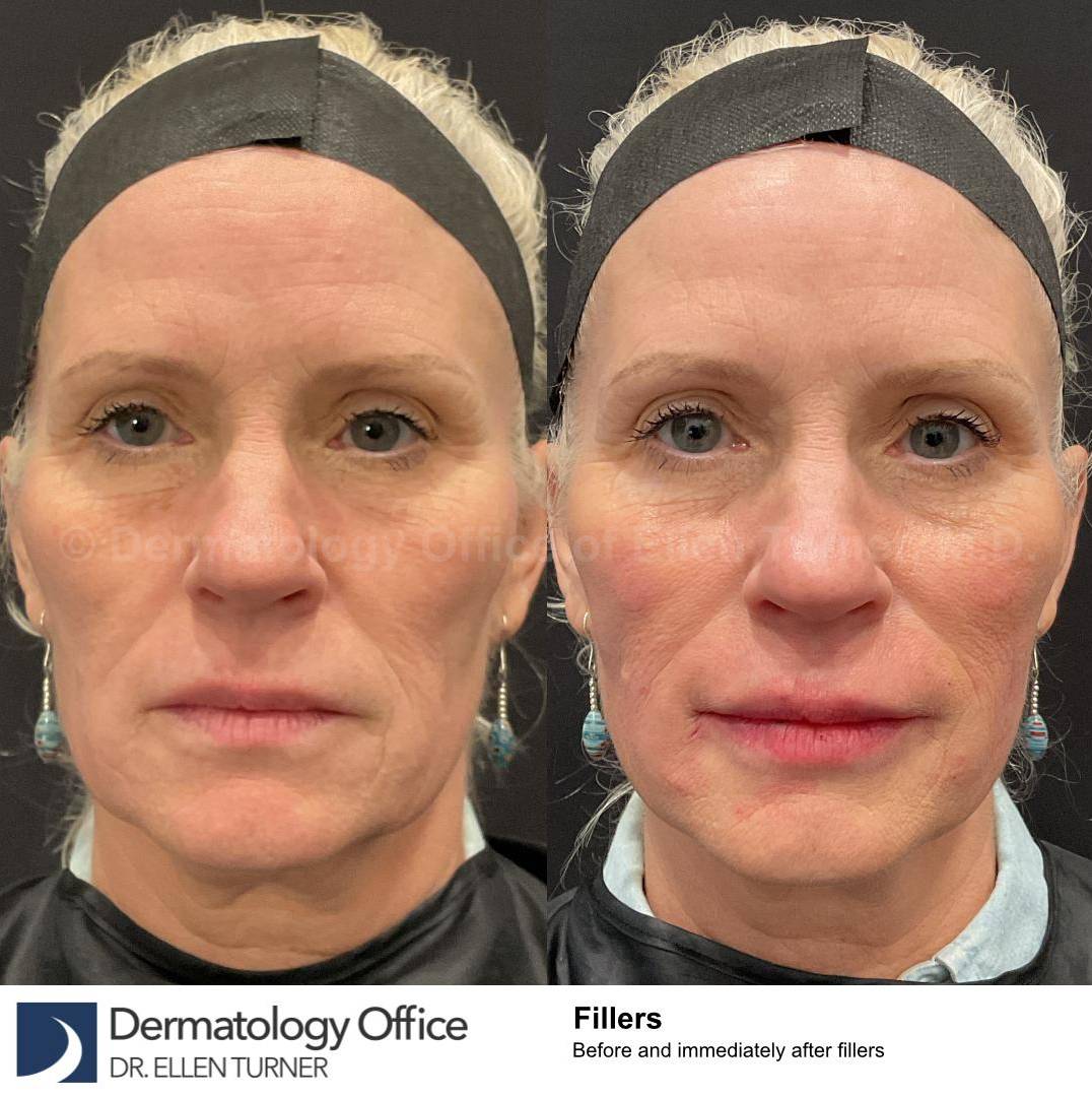 Teoxane Revance Filler Case 8 