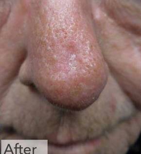 Skin Cancer Before and After Case 4 After