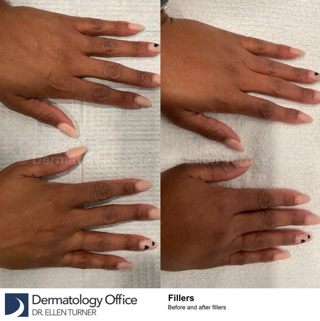 Fillers Before and After Case 3 